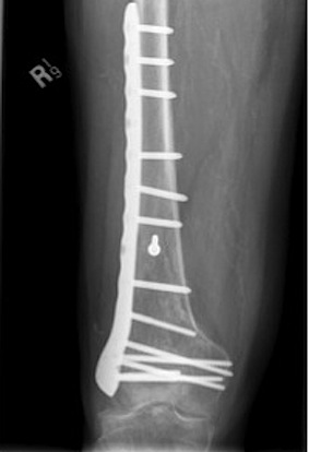 Supracondylar Plate ORIF